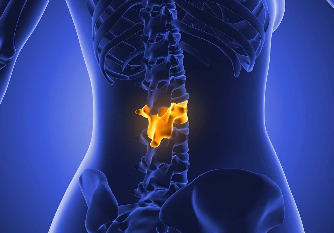 Disc Injuries